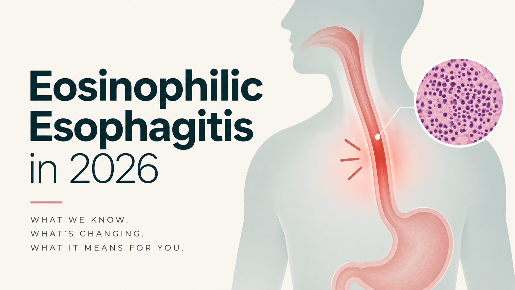 Eosinophilic Esophagitis in 2026: Why Histologic Remission Doesn't Guarantee Symptom Relief