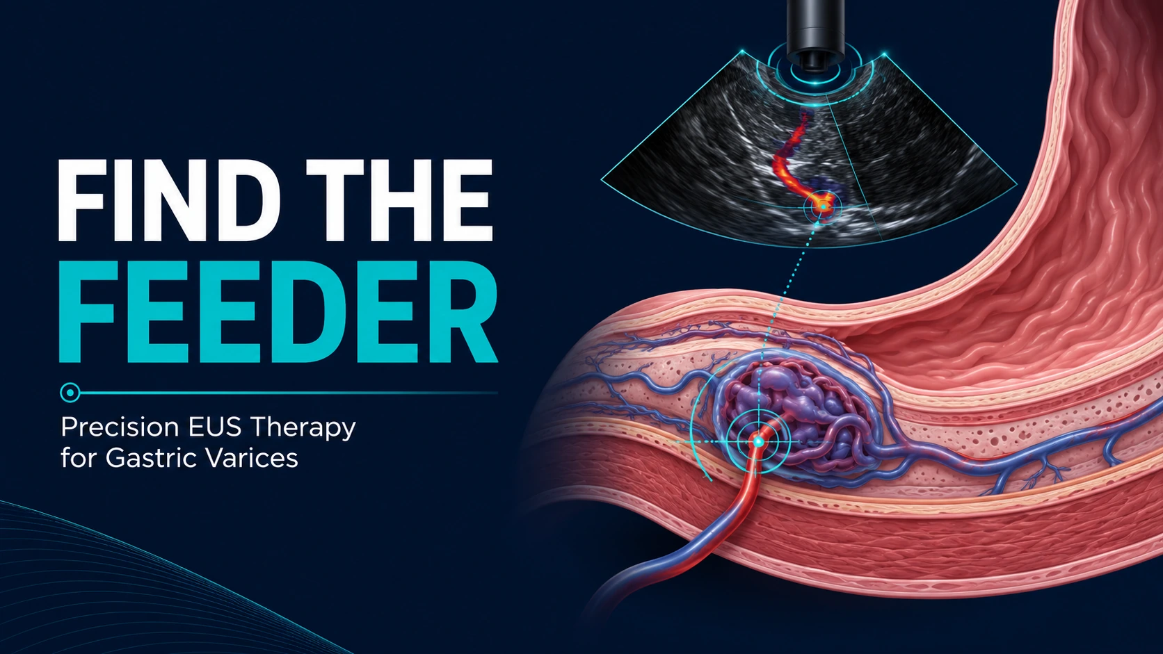 Find the Feeder: What Precision EUS Targeting May Change in Gastric Variceal Therapy